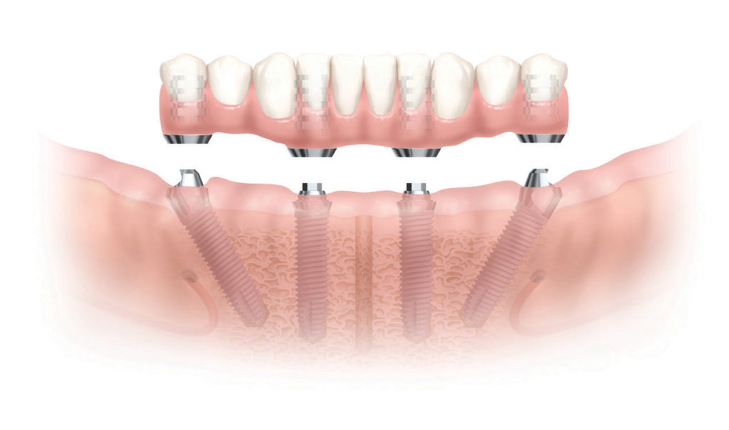implantologia dentale